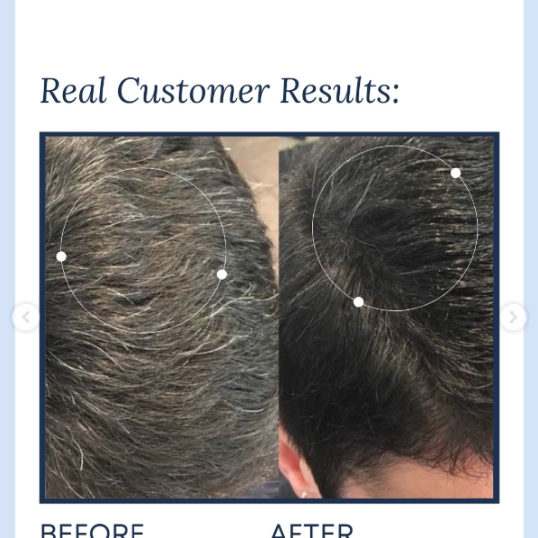 Proskire Anti-Grey Hair Serum | Reduces White Hair | Controls Hair Fall