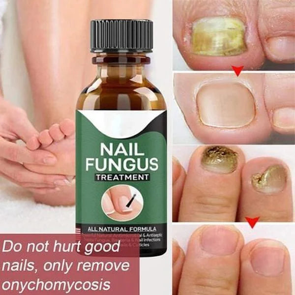 Nail Fungus Serum