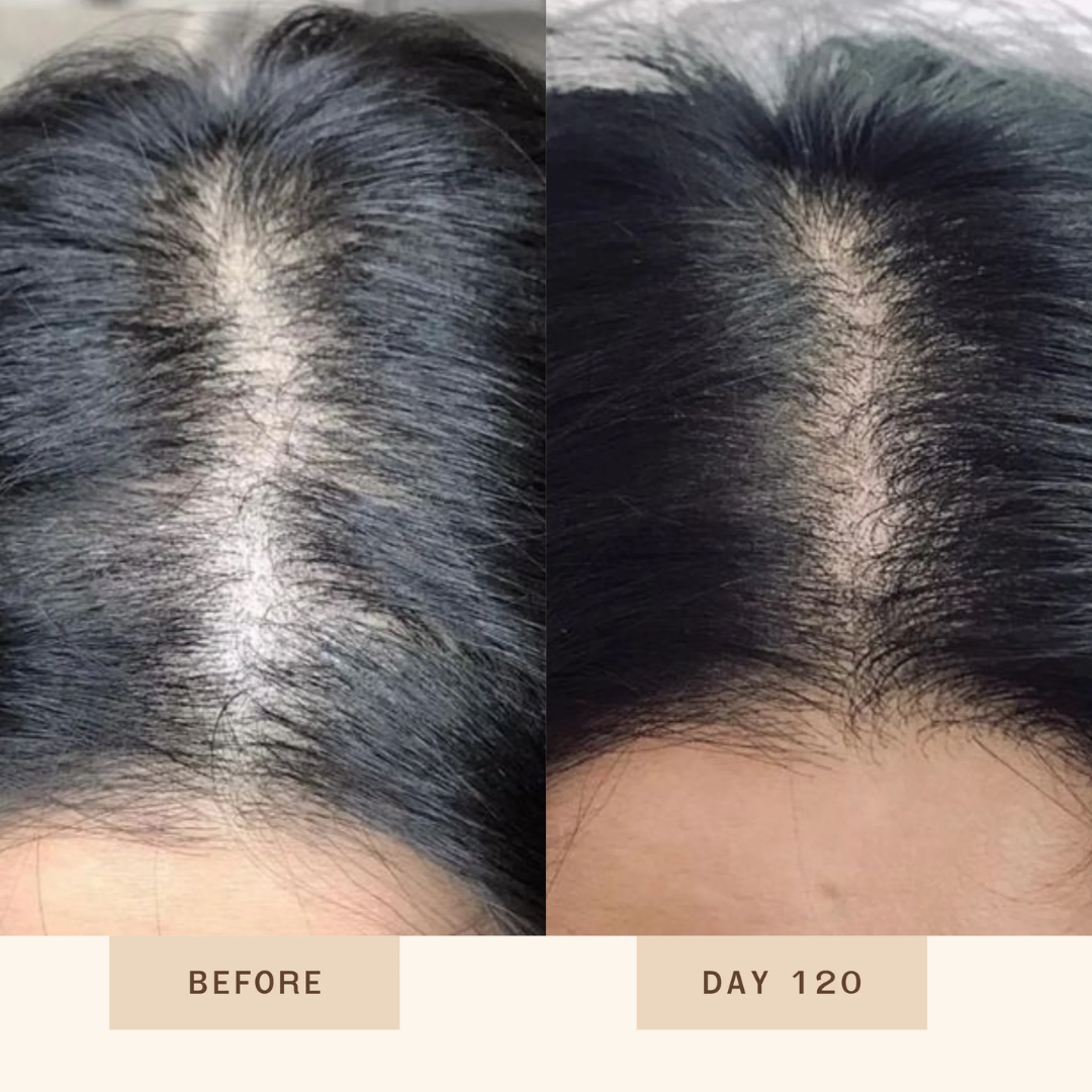 Proskire Anti-Grey Hair Serum | Reduces White Hair | Controls Hair Fall