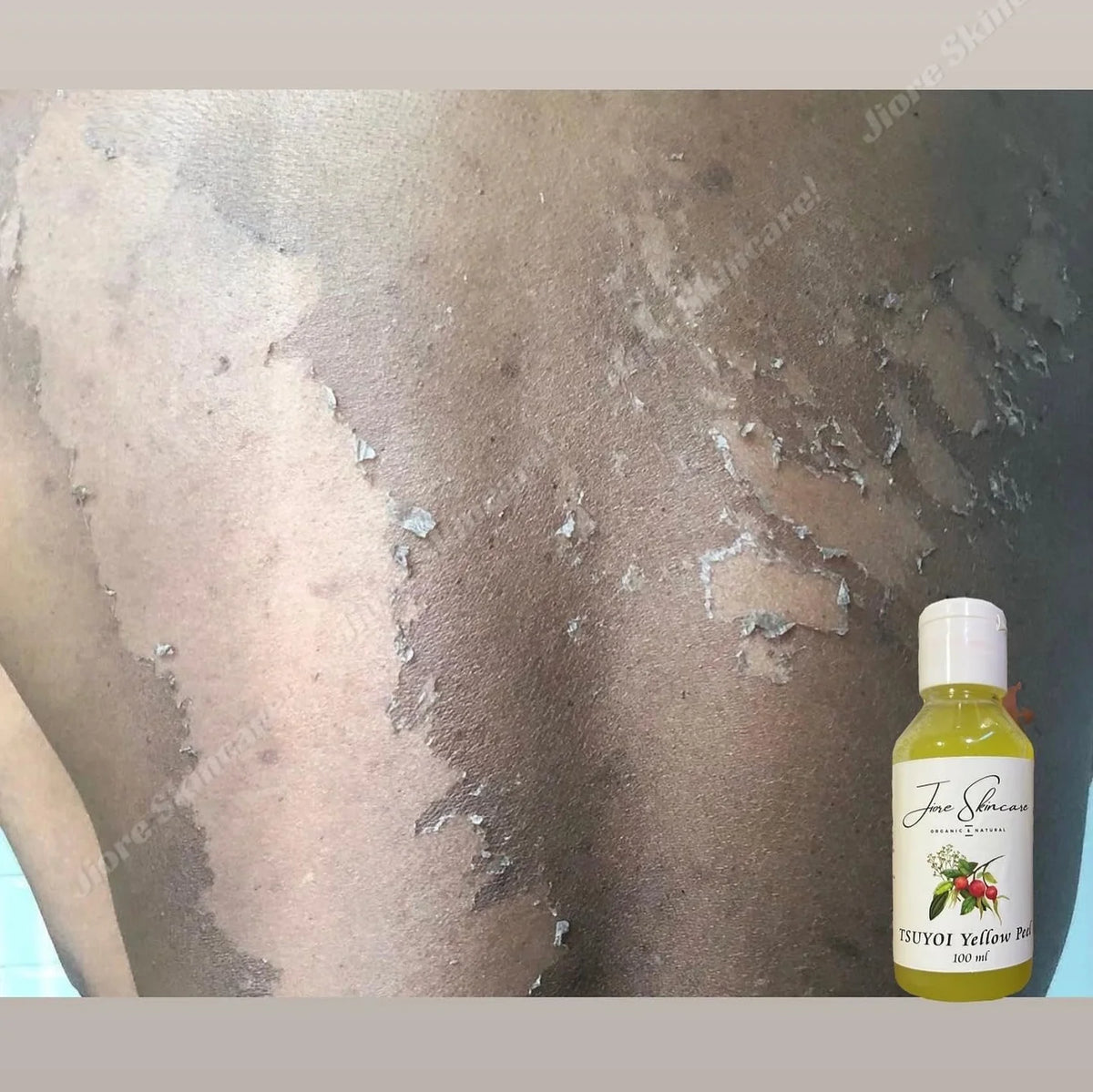 Jiore Tsuyoi Oil Skin Whitening Yellow Peel Brightening & Exfoliating Treatment Skin